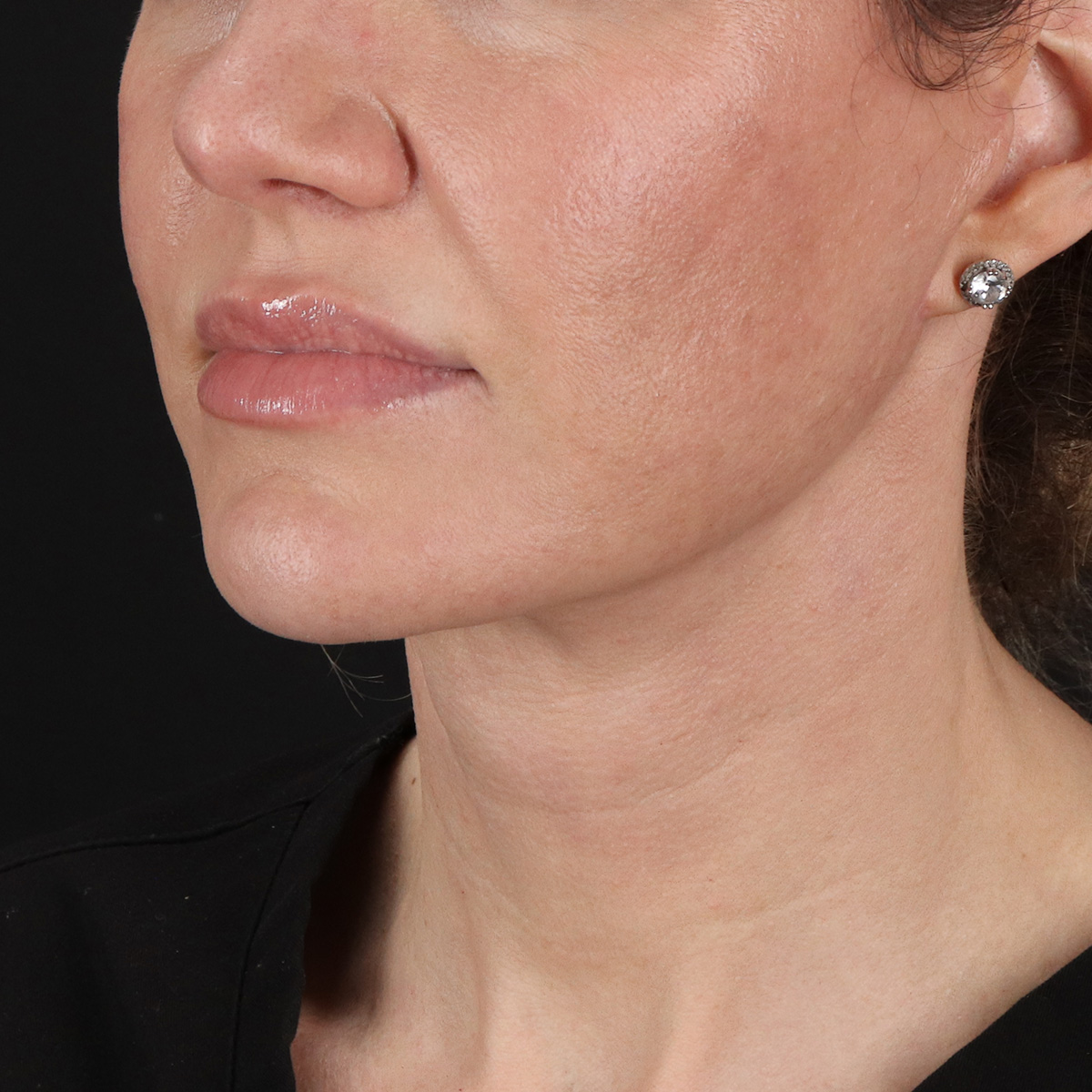 Neck Lift Before & After Patient #2626
