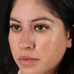 Fillers Before & After Patient #2063