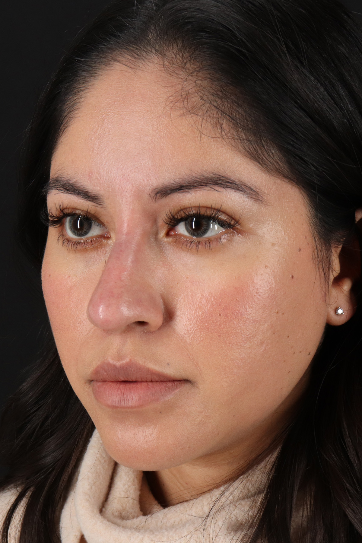Liquid Rhinoplasty Before & After Patient #2290
