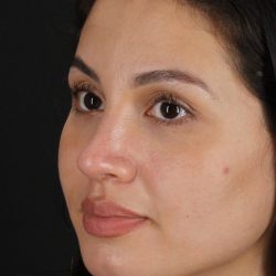 Rhinoplasty Before & After Patient #3236