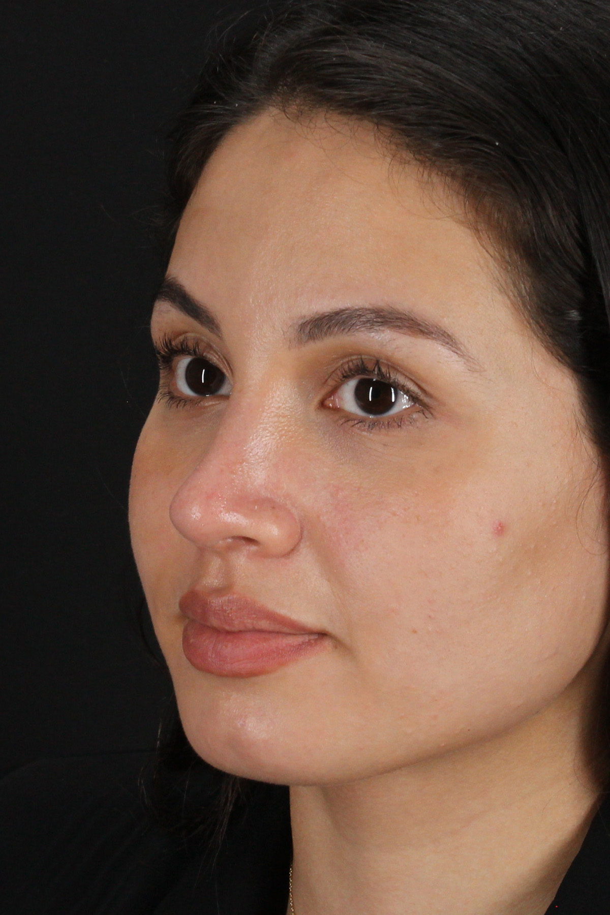 Rhinoplasty Before & After Patient #3236