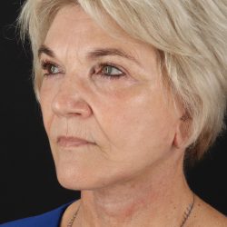 Facelift Before & After Patient #1943