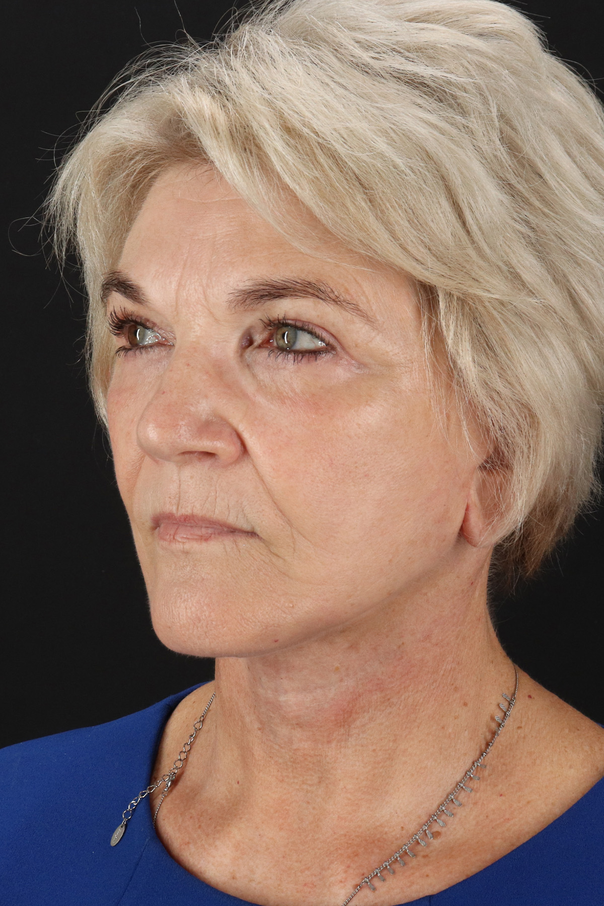 Neck Lift Before & After Patient #2648