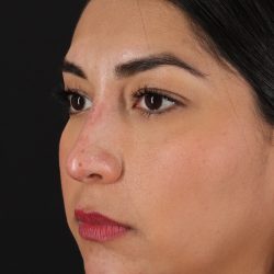 Liquid Rhinoplasty Before & After Patient #2232