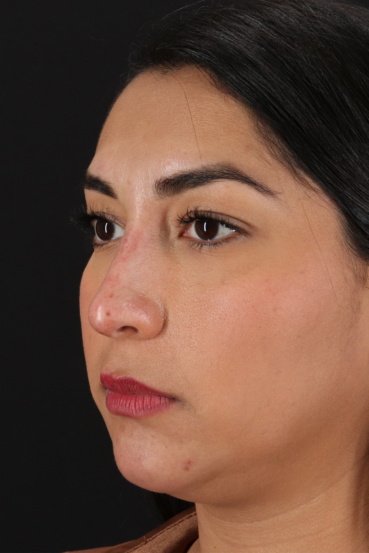 Liquid Rhinoplasty Before & After Patient #2232