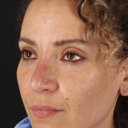 Liquid Rhinoplasty Before & After Patient #2276