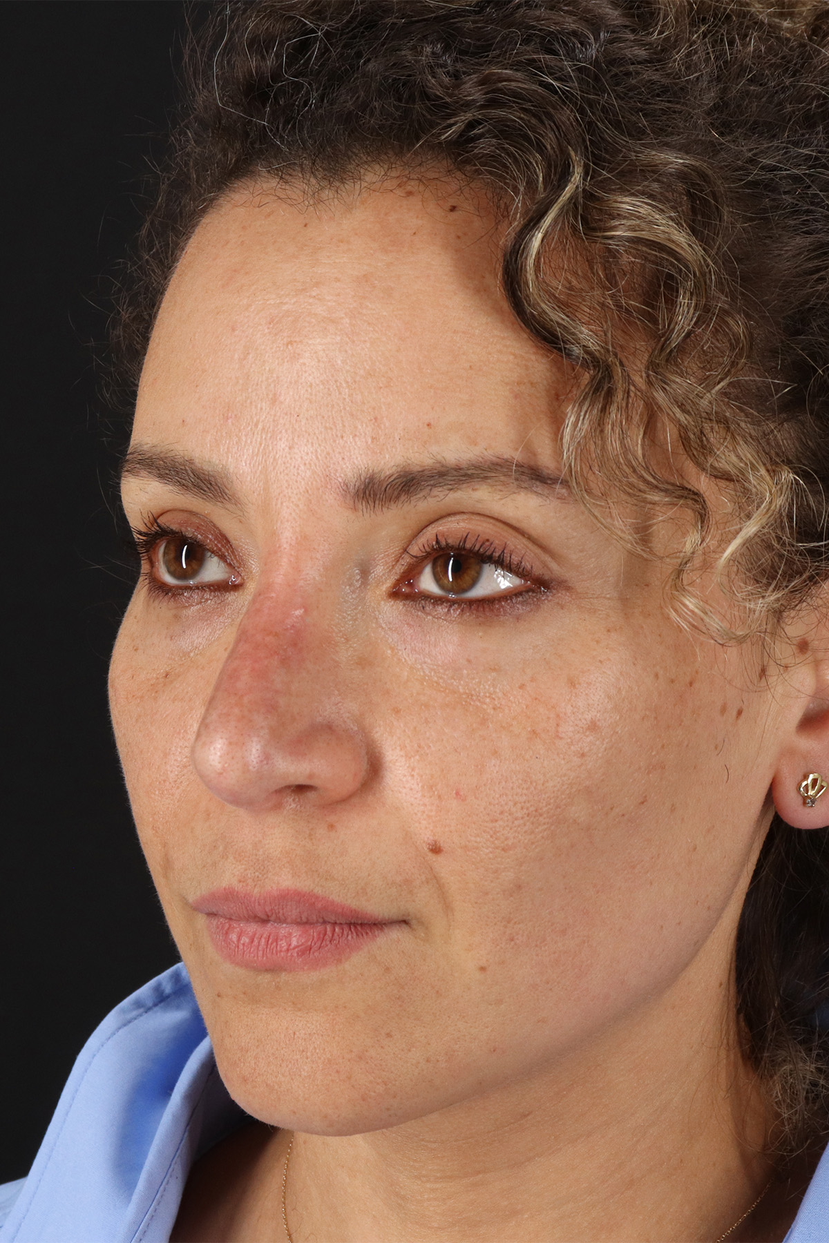 Liquid Rhinoplasty Before & After Patient #2276