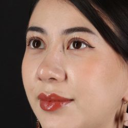 Rhinoplasty Before & After Patient #3159