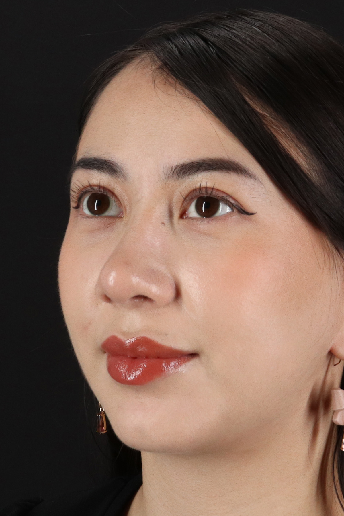 Rhinoplasty Before & After Patient #3159