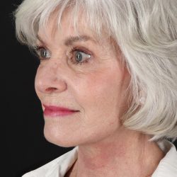 Upper Blepharoplasty Before & After Patient #5377