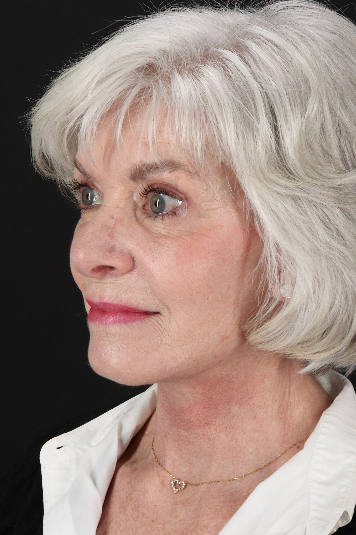 Upper Blepharoplasty Before & After Patient #5377