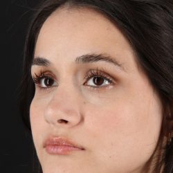 Rhinoplasty Before & After Patient #3258