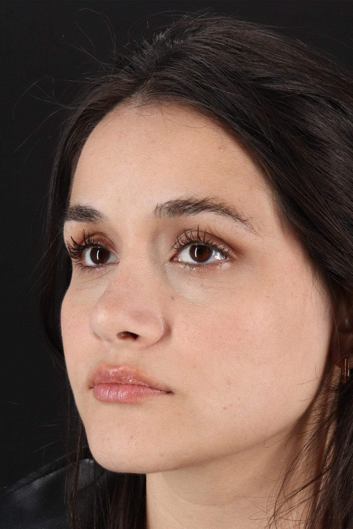 Rhinoplasty Before & After Patient #3258