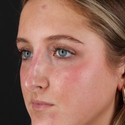 Liquid Rhinoplasty Before & After Patient #2221