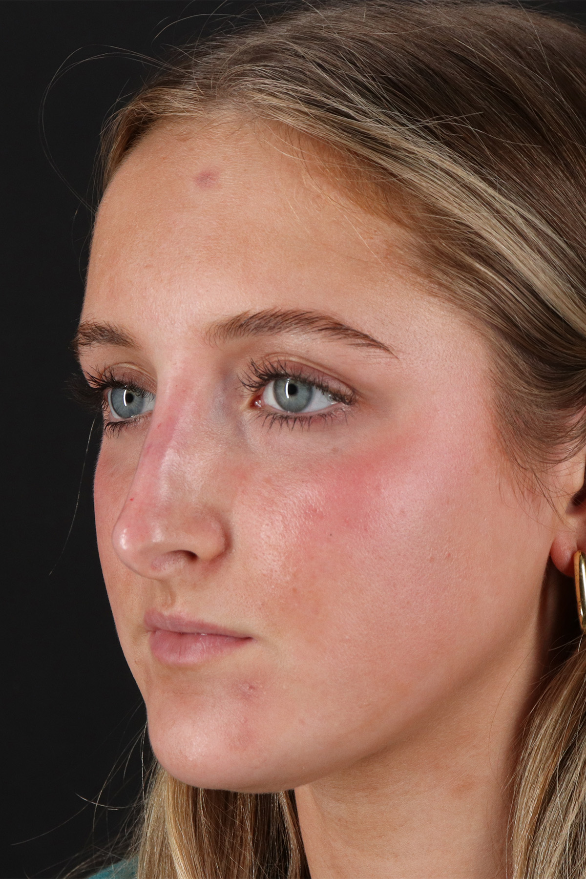 Liquid Rhinoplasty Before & After Patient #2221