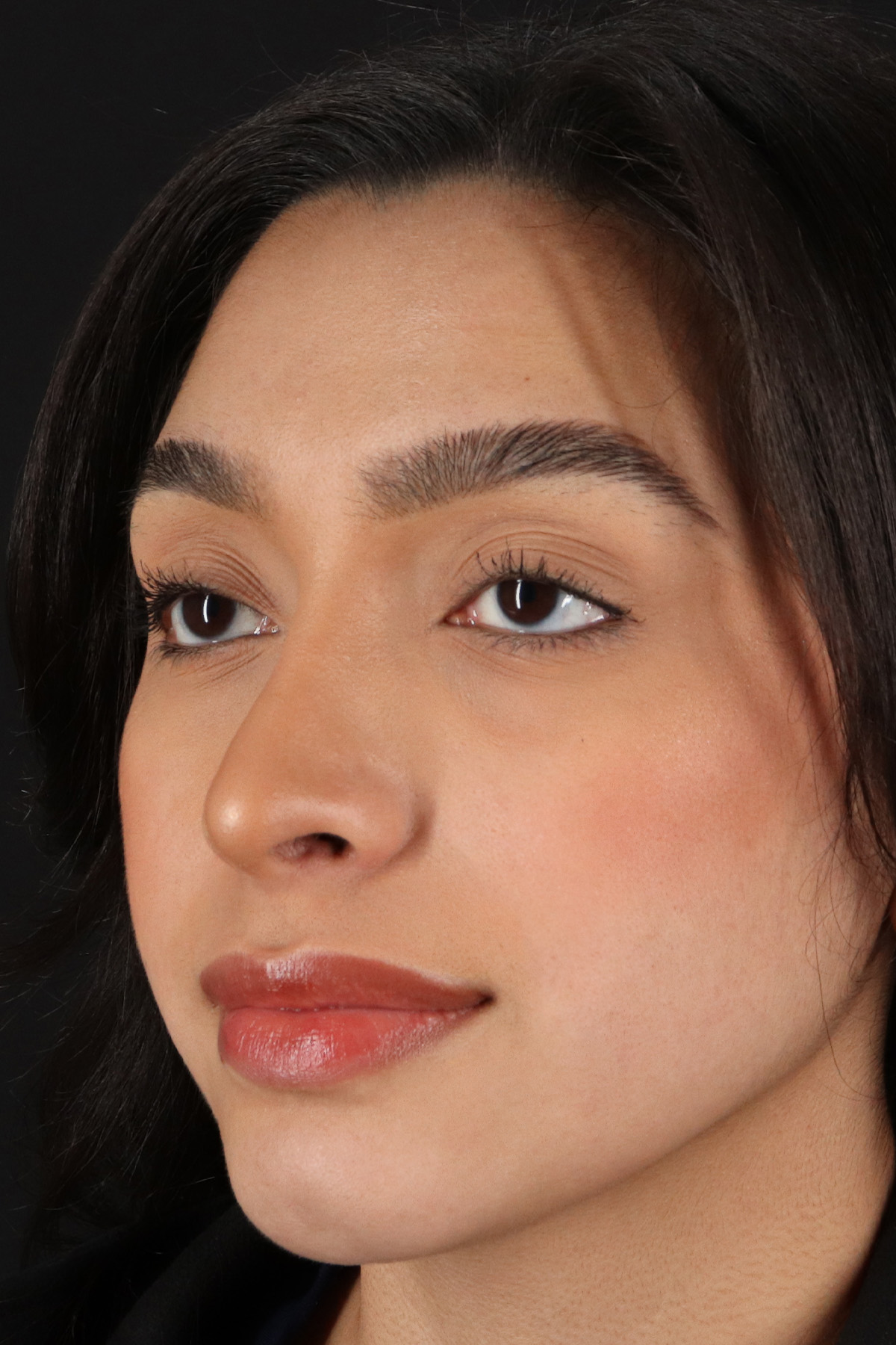 Chin Implant Before & After Patient #1637