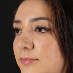 Rhinoplasty Before & After Patient #3115
