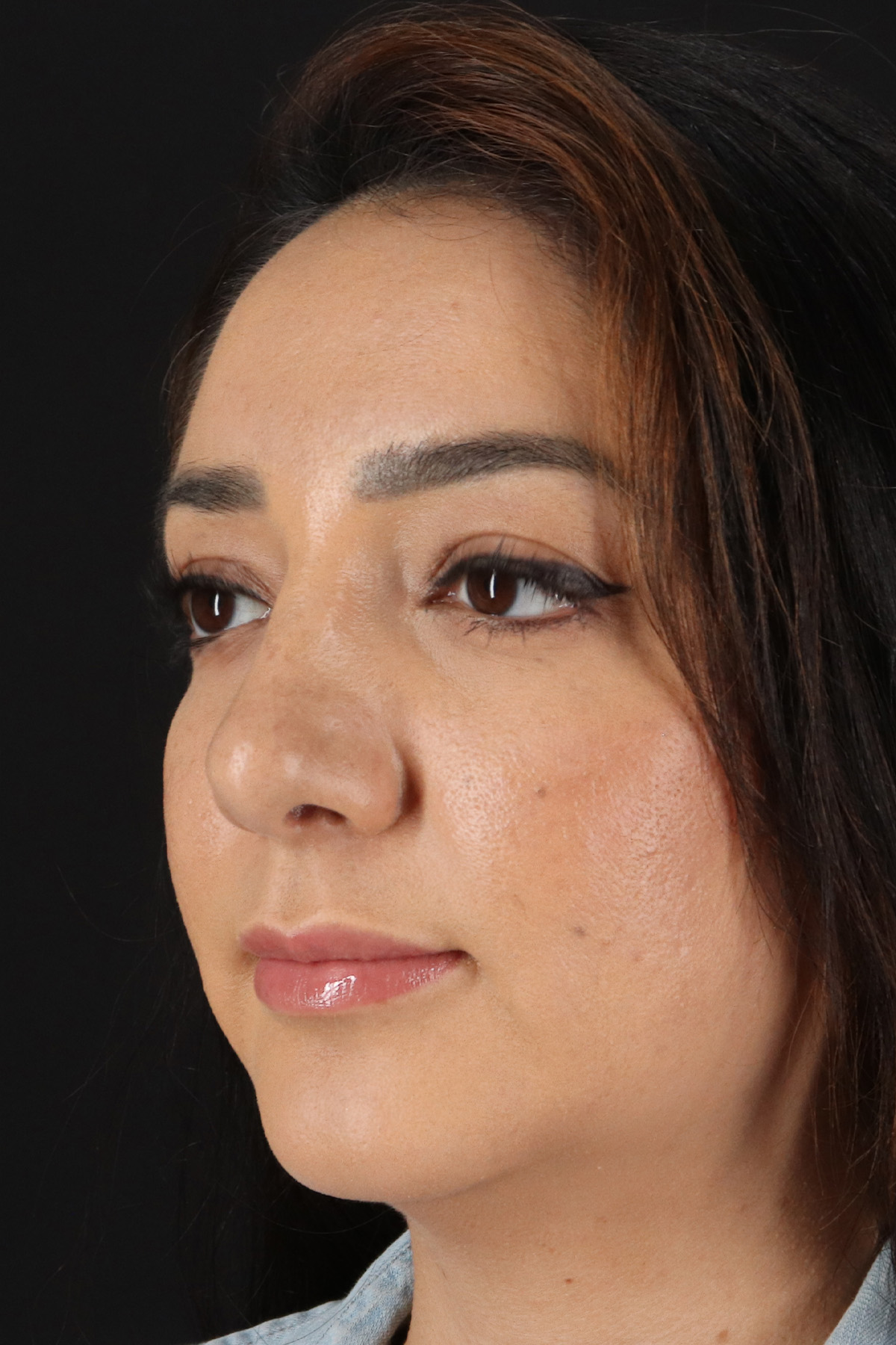 Rhinoplasty Before & After Patient #3115