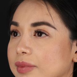 Chin Implant Before & After Patient #1626