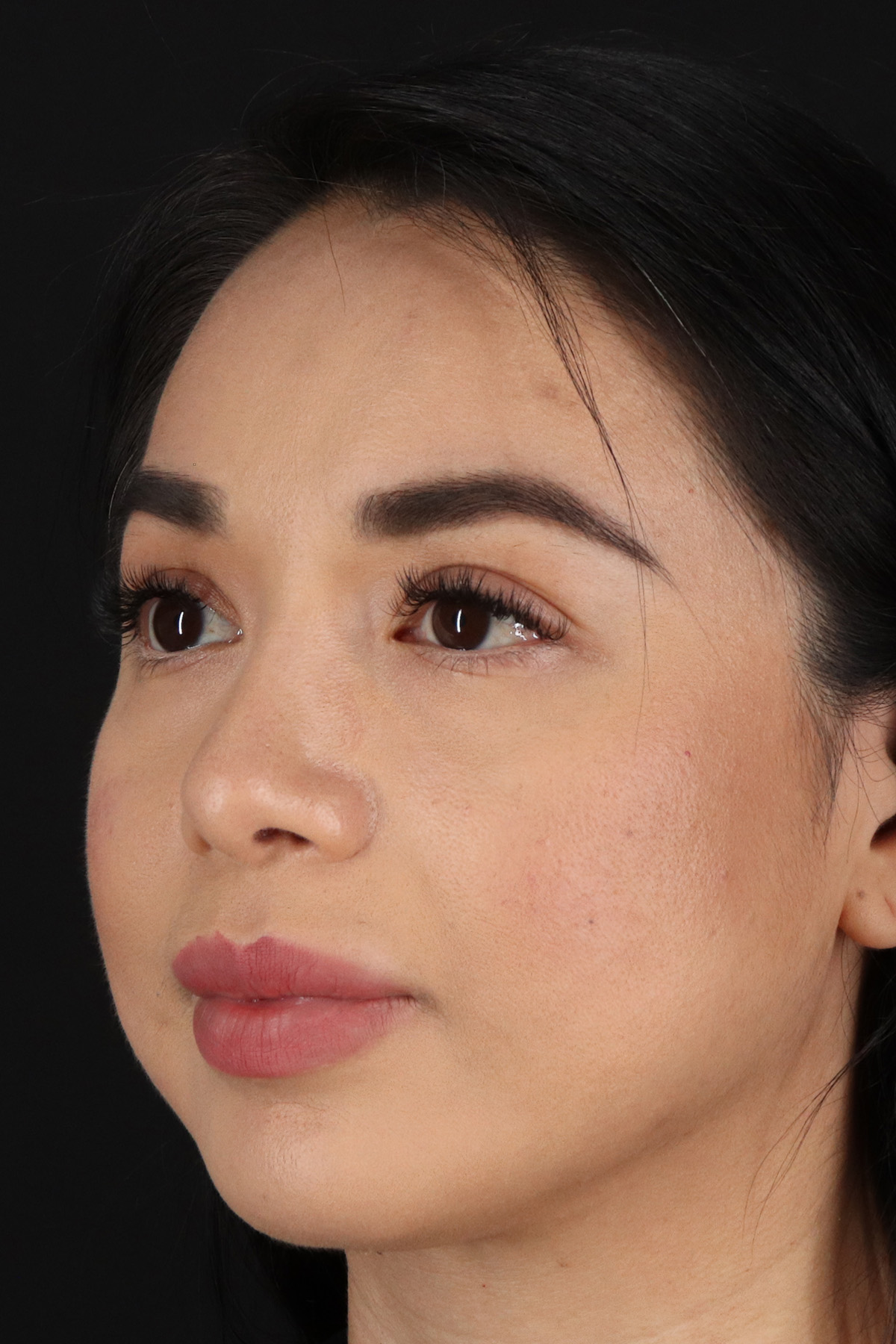 Chin Implant Before & After Patient #1626