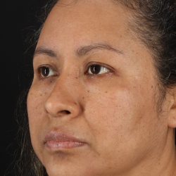Rhinoplasty Before & After Patient #3225