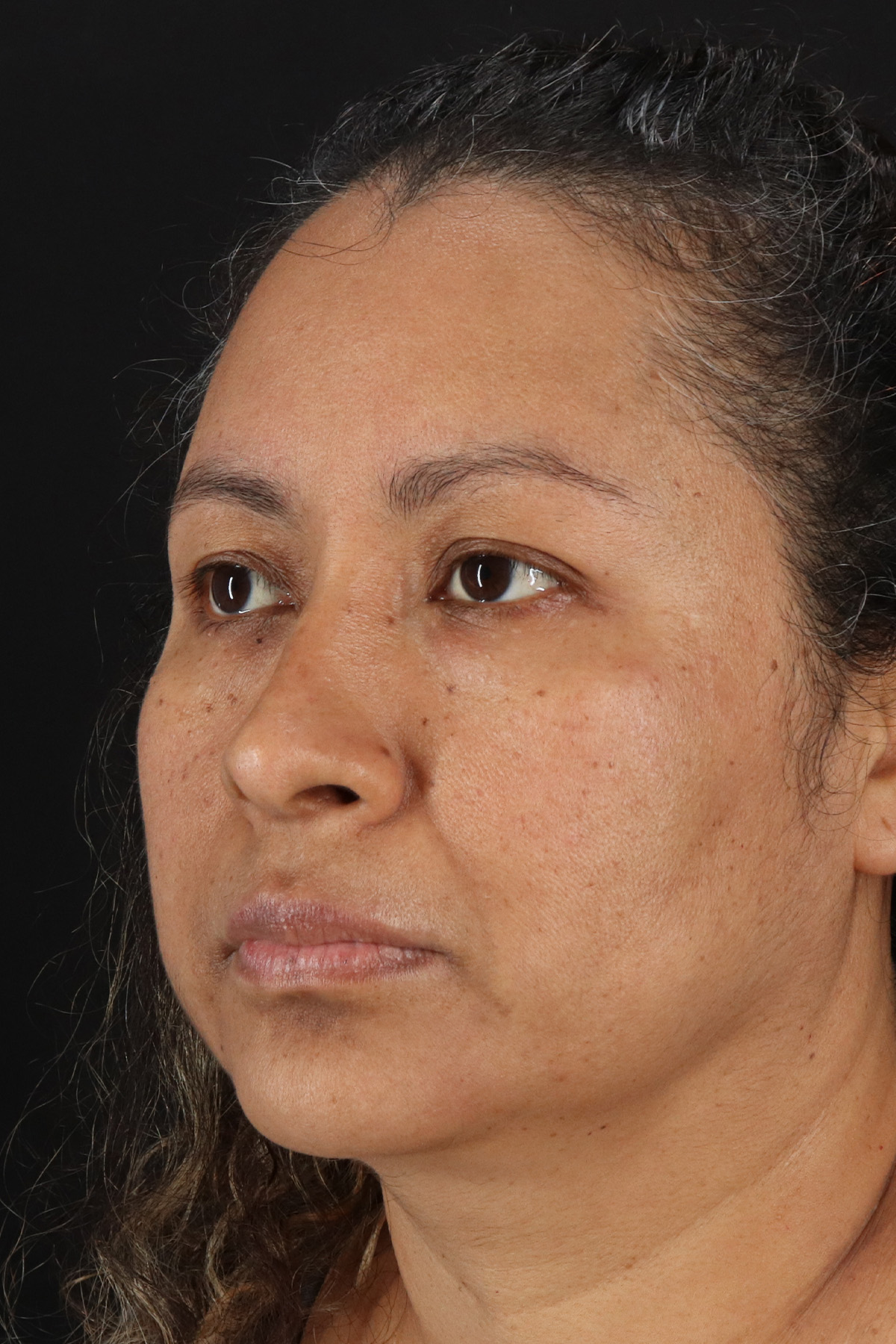 Rhinoplasty Before & After Patient #3225