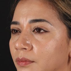 Rhinoplasty Before & After Patient #3082