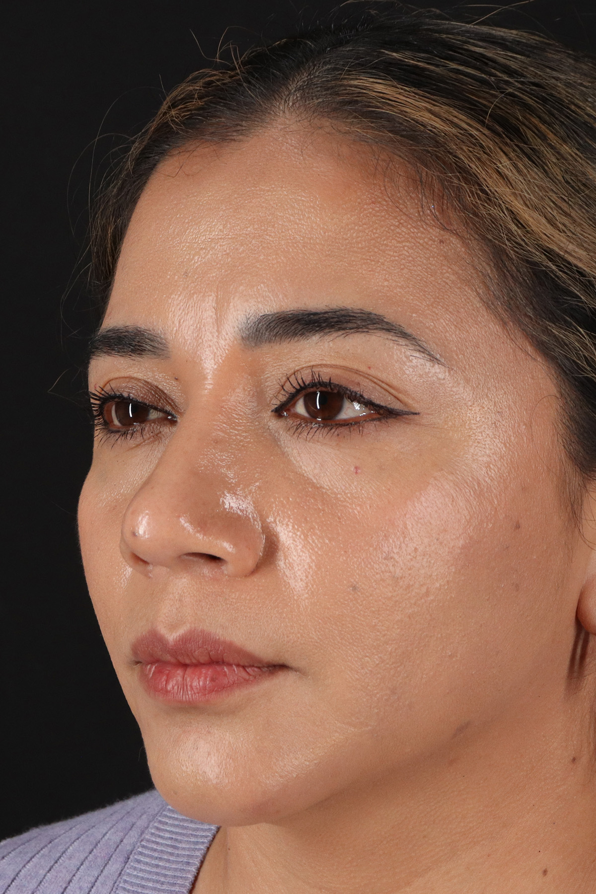Rhinoplasty Before & After Patient #3082