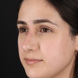 Liquid Rhinoplasty Before & After Patient #2188