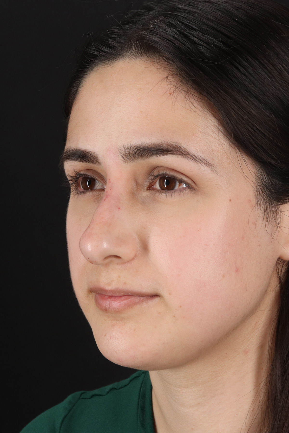 Liquid Rhinoplasty Before & After Patient #2188