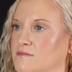 Rhinoplasty Before & After Patient #3126