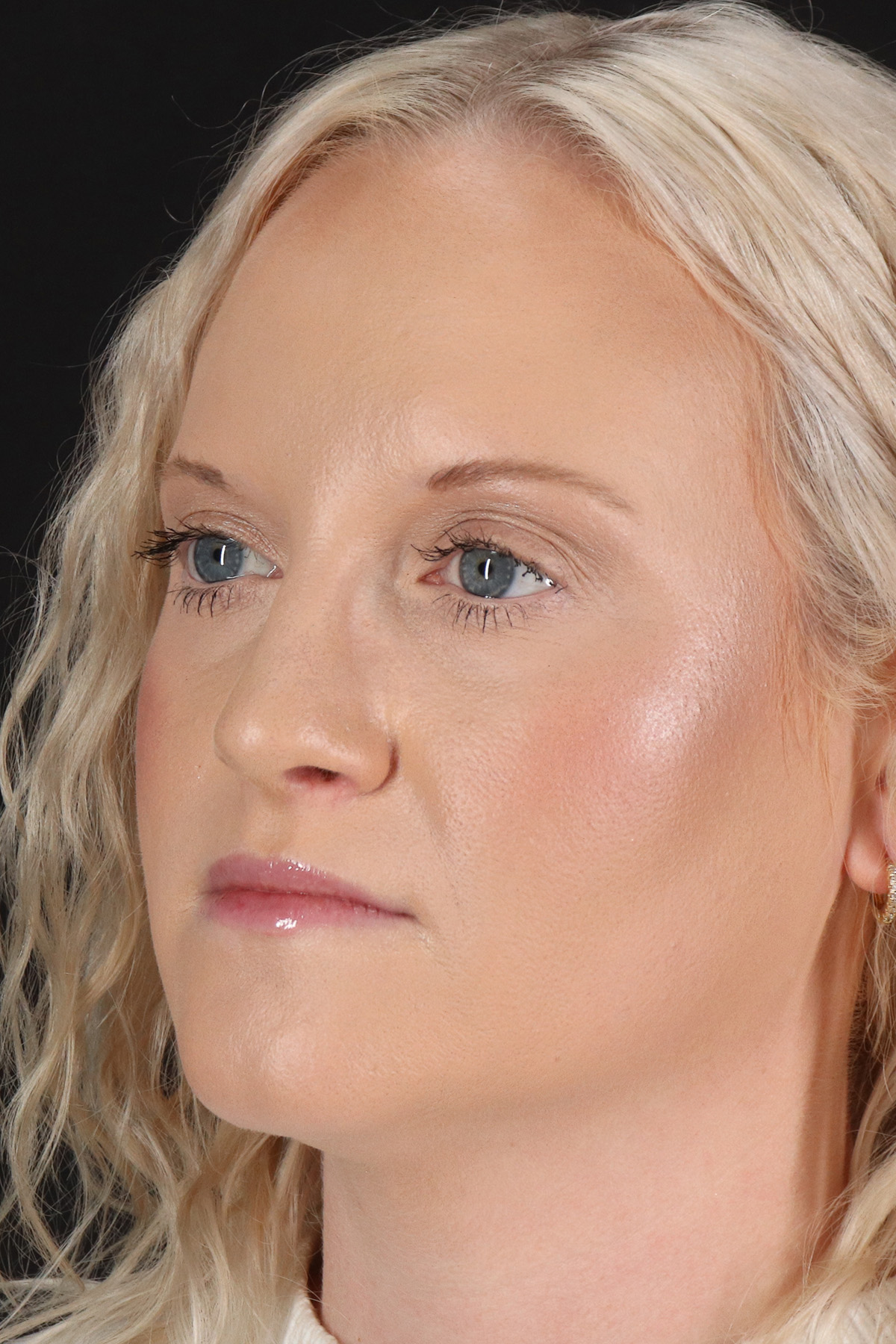 Rhinoplasty Before & After Patient #3126