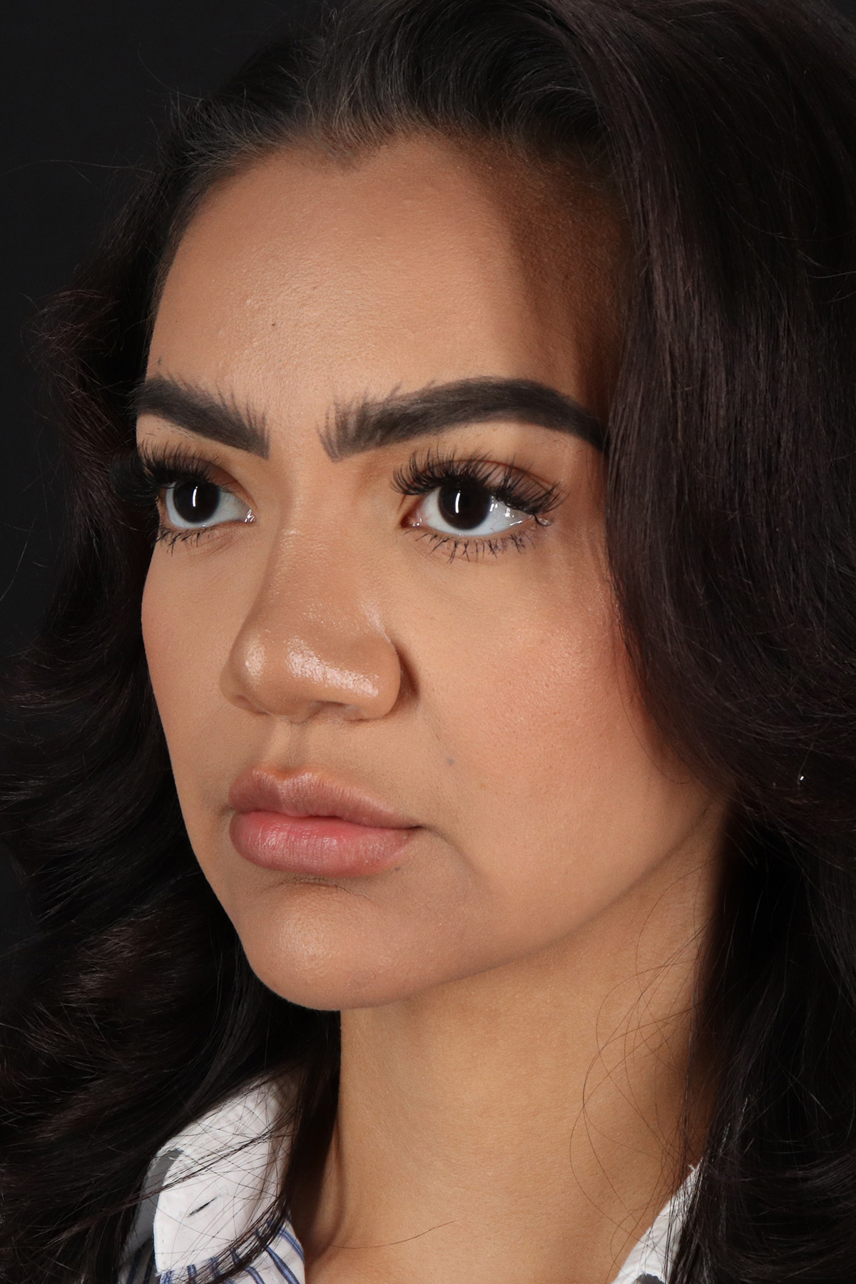 Rhinoplasty Before & After Patient #3192