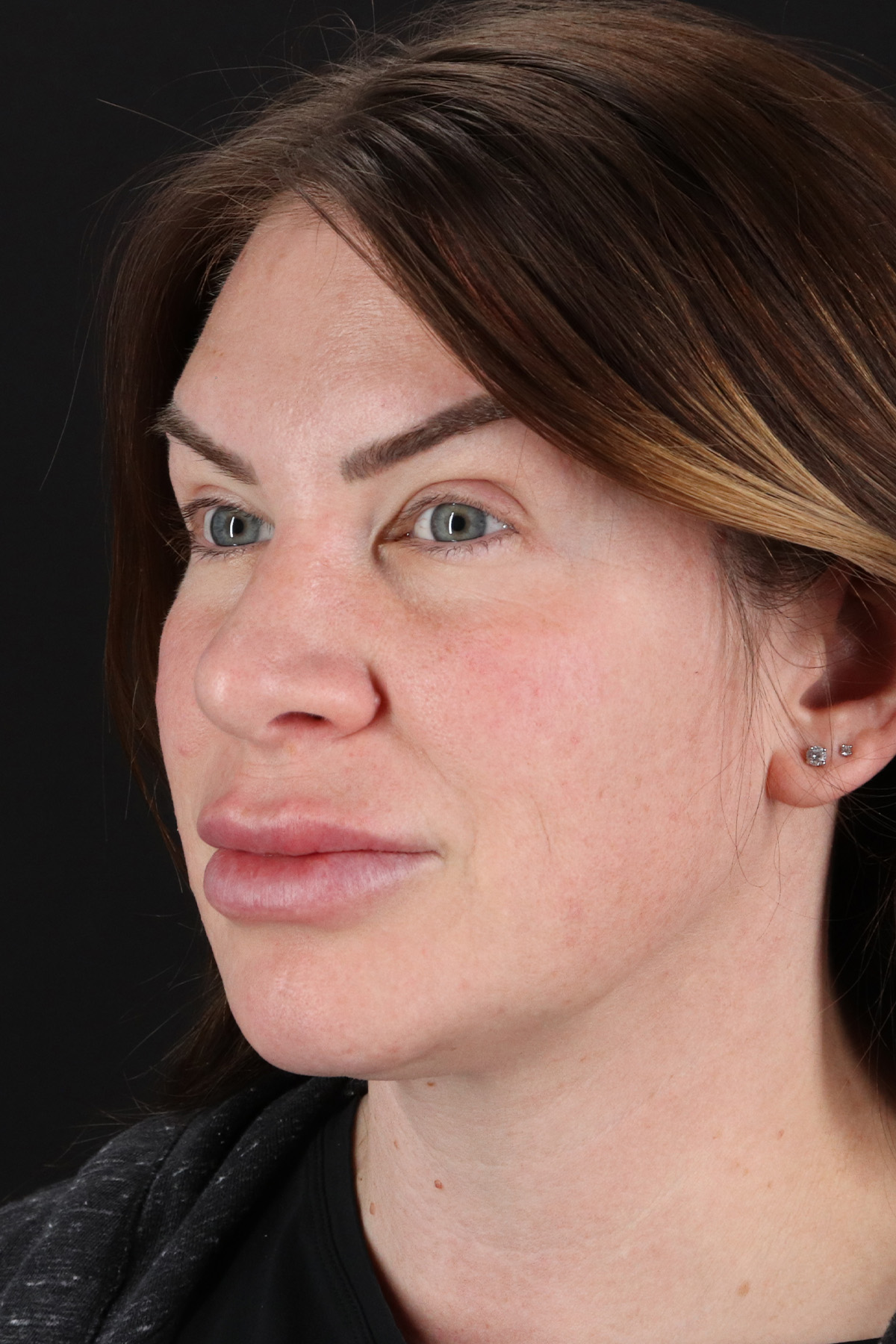 Rhinoplasty Before & After Patient #3093