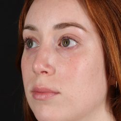 Rhinoplasty Before & After Patient #3170