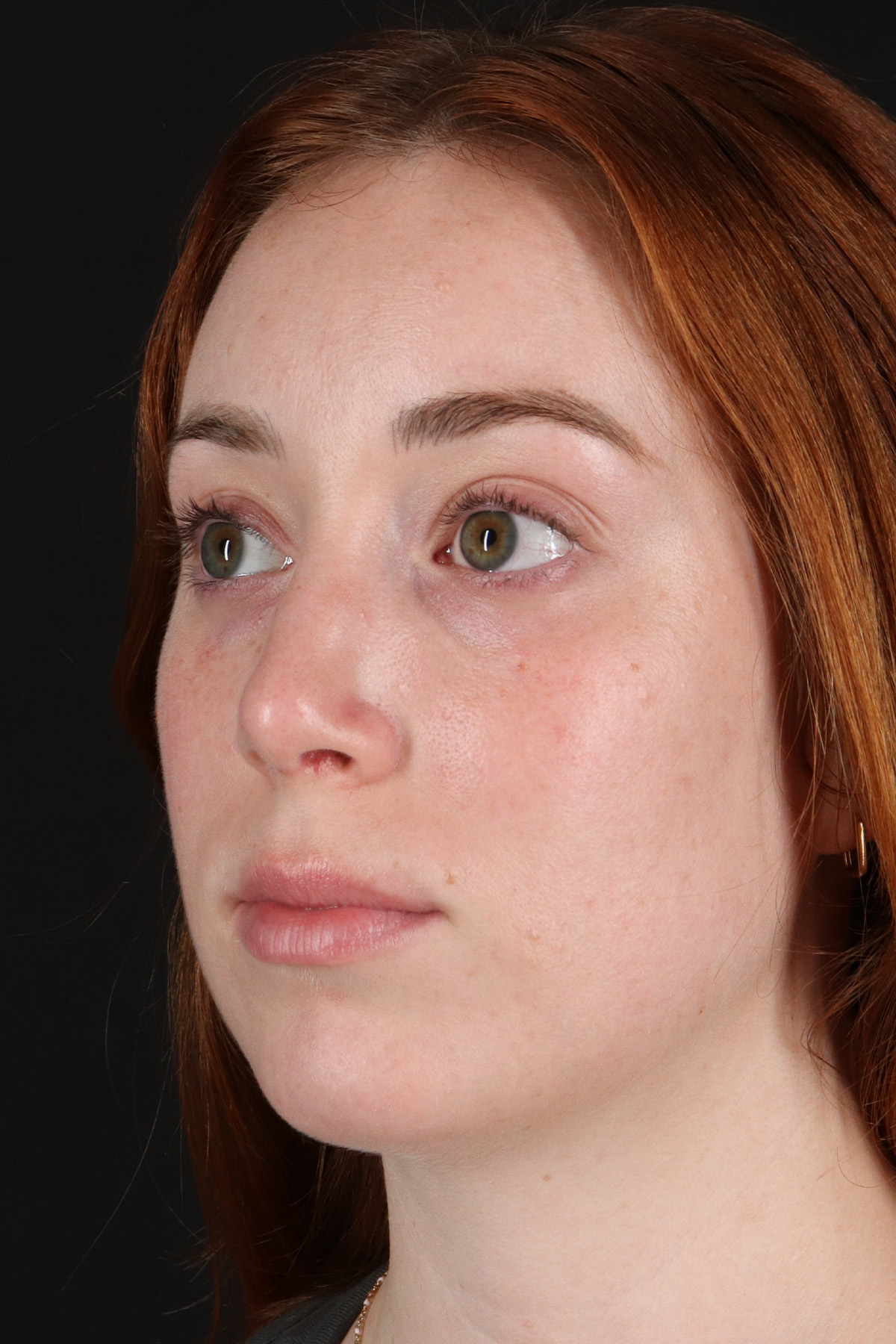 Rhinoplasty Before & After Patient #3170