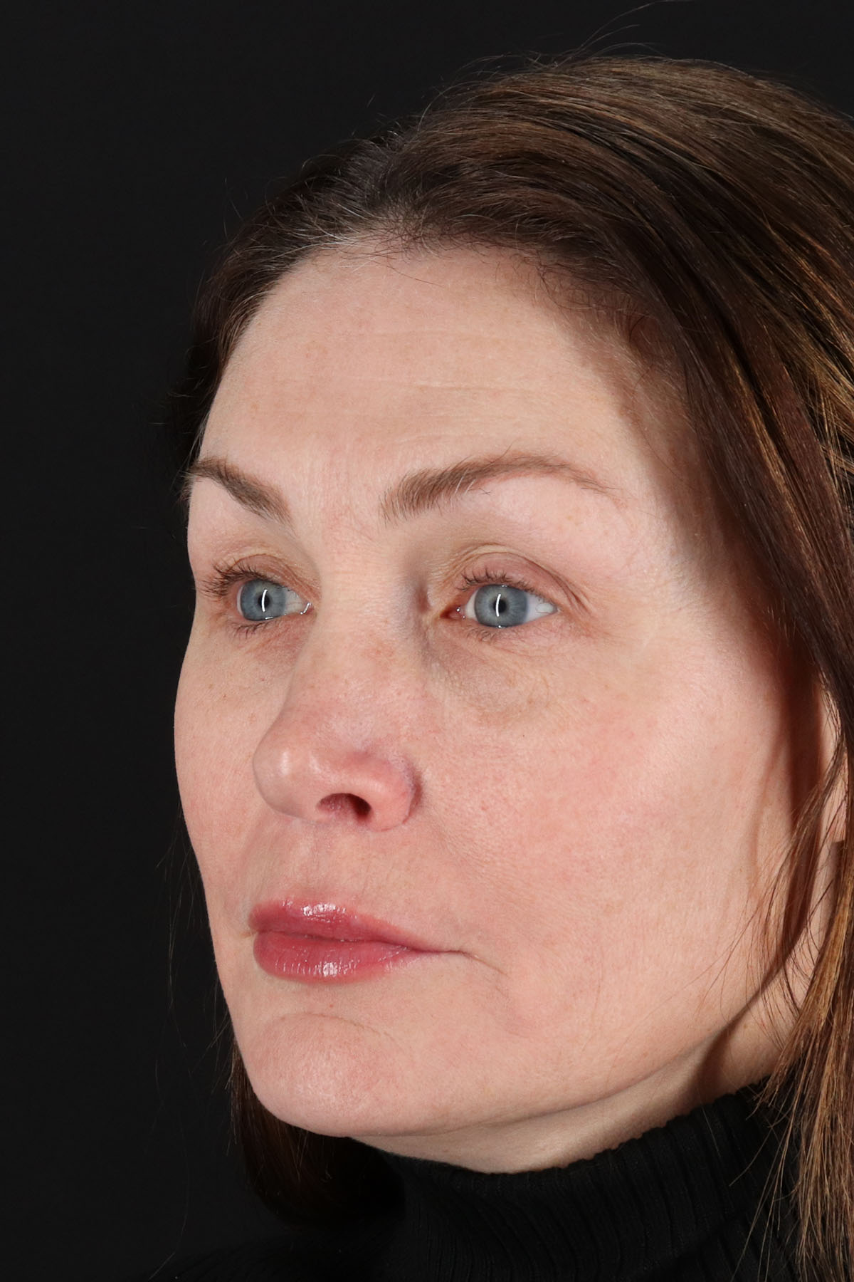 Lip Lift Before & After Patient #2144