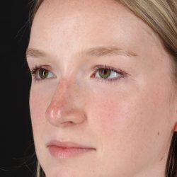 Liquid Rhinoplasty Before & After Patient #2177