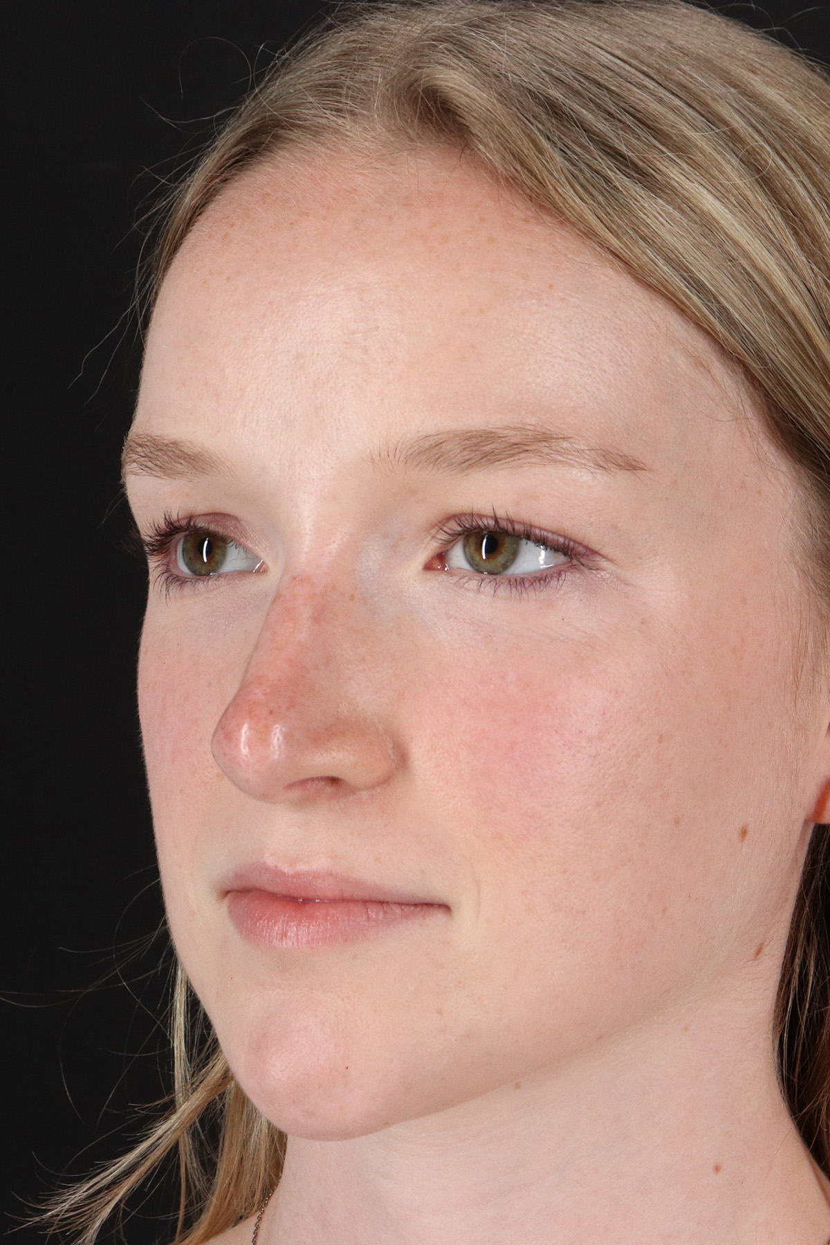 Liquid Rhinoplasty Before & After Patient #2177