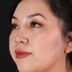 Rhinoplasty Before & After Patient #3060