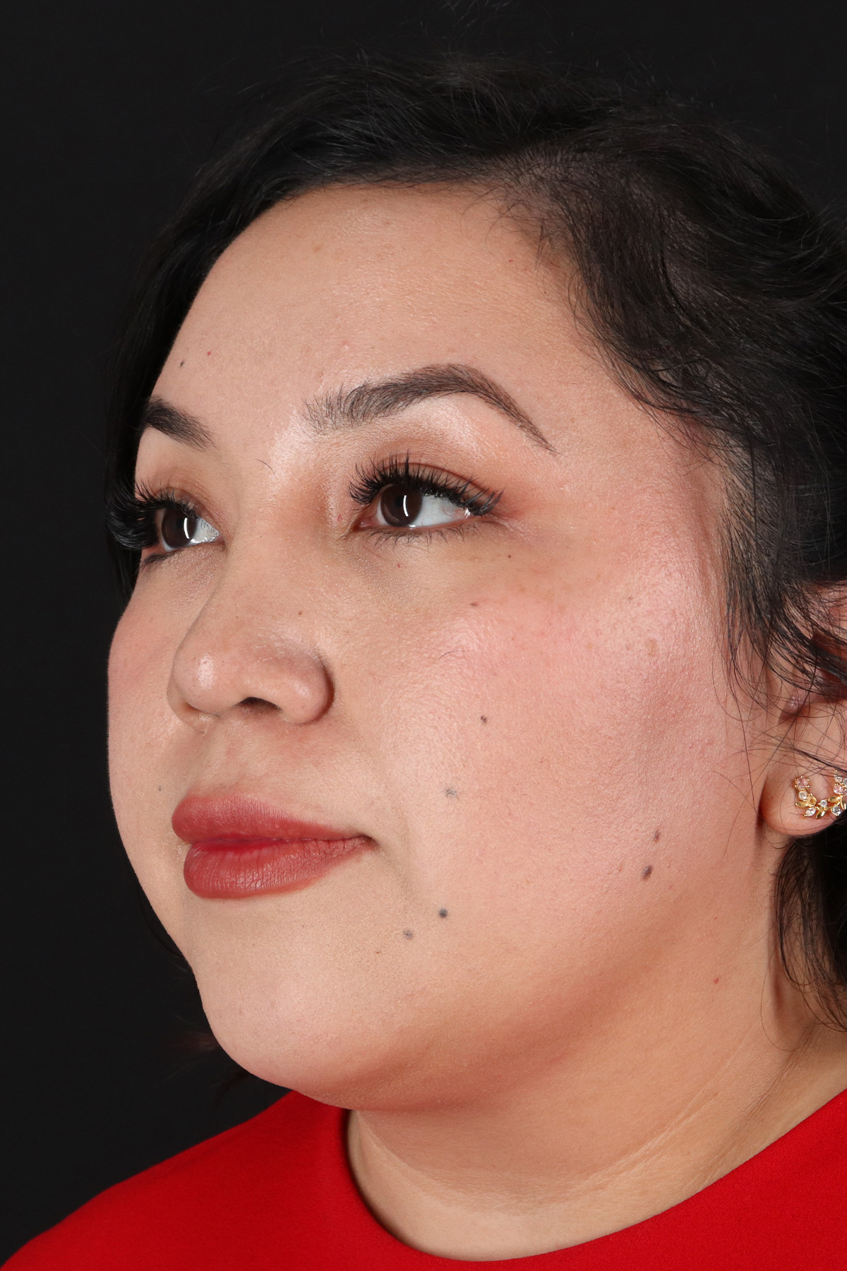 Rhinoplasty Before & After Patient #3060