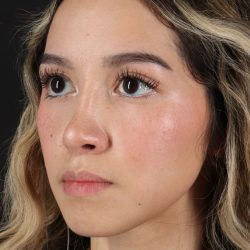 Rhinoplasty Before & After Patient #3302