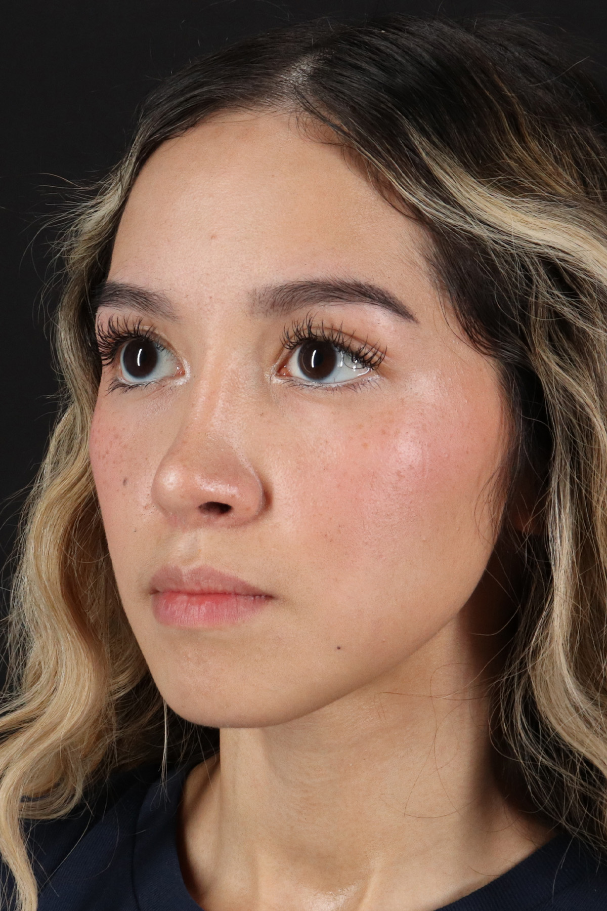 Rhinoplasty Before & After Patient #3302