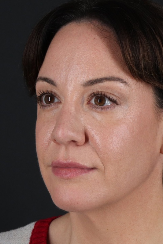 Browlift Before & After Patient #1363