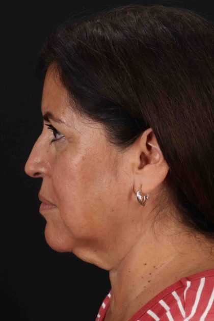 Facelift Before & After Patient #3544