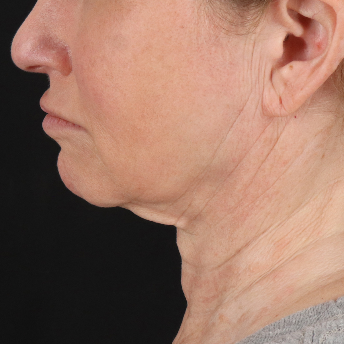 Facelift Before & After Patient #1866