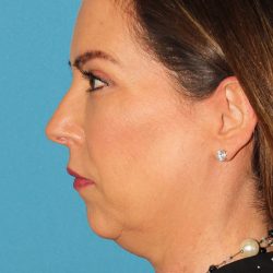 Chin Implant Before & After Patient #1659