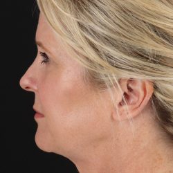 Neck Lift Before & After Patient #2582