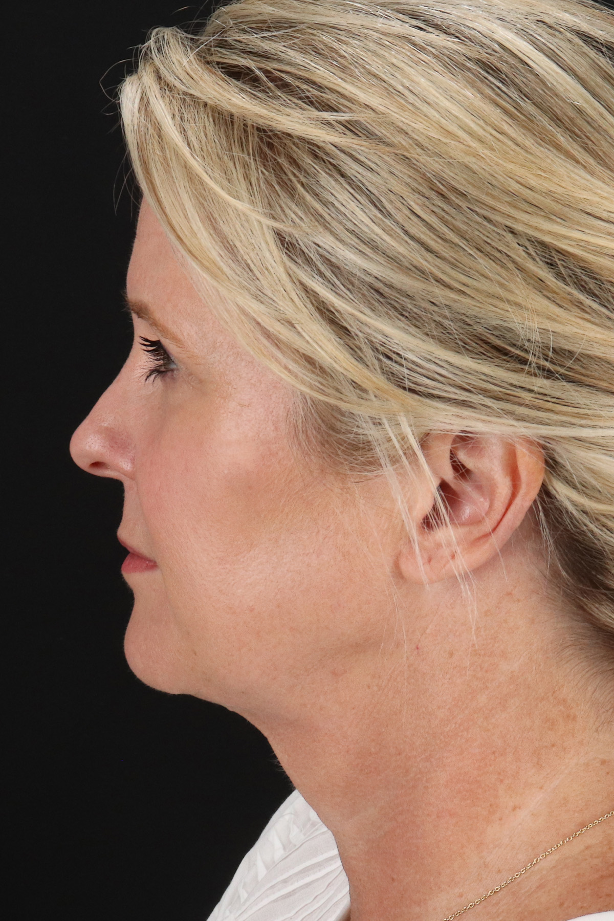 Facelift Before & After Patient #1877