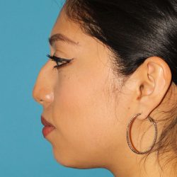 Chin Implant Before & After Patient #1670